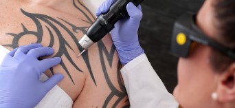Laserowe usuwanie tatuażu - o zabiegu opowiada dermatolog