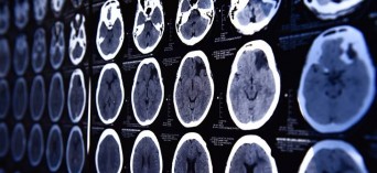 Udar mózgu - jak leczeni są polscy pacjenci? Raport NIK