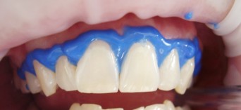 Wybielanie zębów: domowe sposoby nie zawsze są bezpieczne